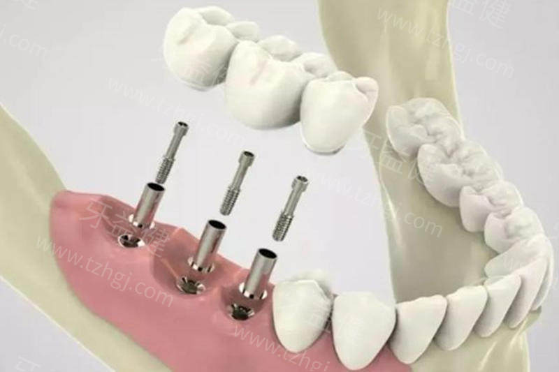 牙槽骨多少mm可以种牙