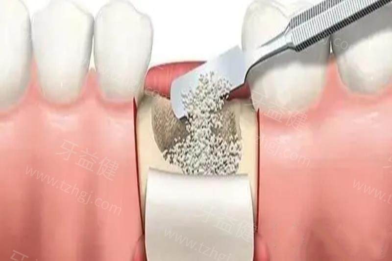 牙槽骨多少mm可以种牙