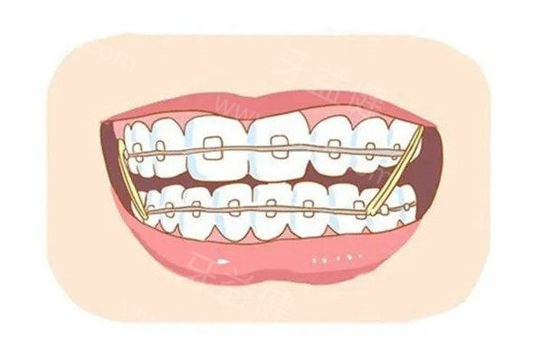 牙齿矫正器