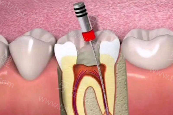 根管治疗步骤