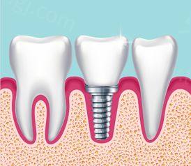 郑州种植牙哪家比较好 郑州种植牙多少钱