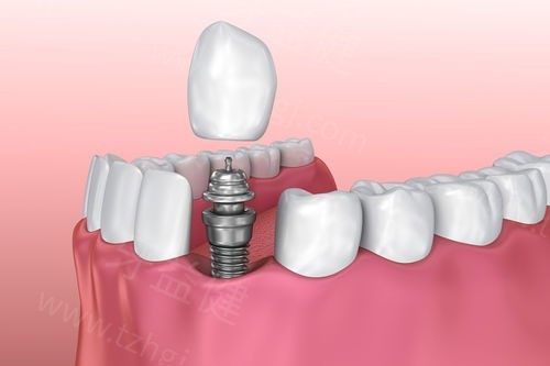 镇江牙科医院种植牙价格表,单颗种植牙6000+半口种植牙3W+很实惠