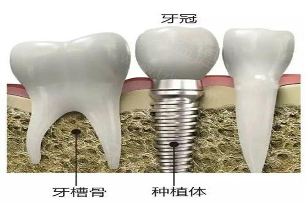 上海种植牙哪家医院好