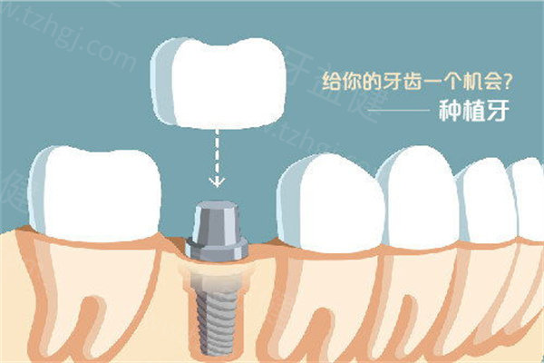 聊城中贝佳口腔门诊部收费贵吗?种植牙2580+矫正4800+价格实惠