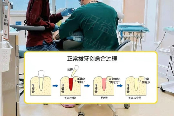 拔牙术后窟窿
