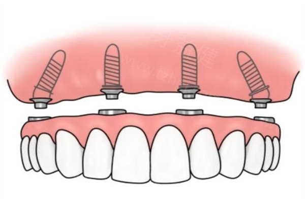 全口假牙