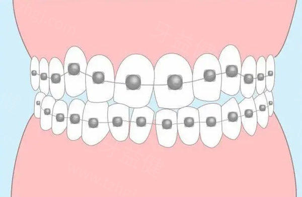 大连市牙齿矫正价格表