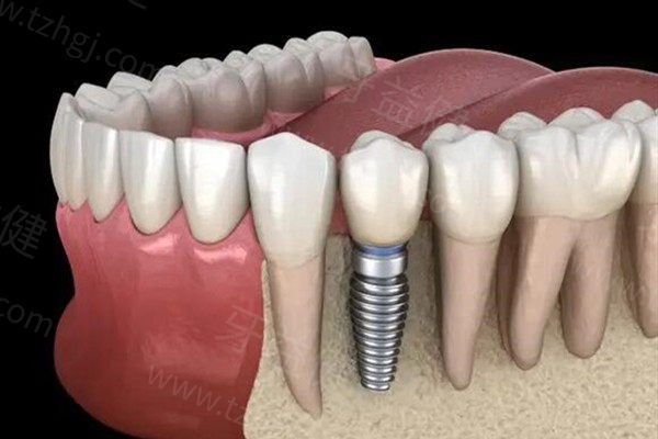 2025年一颗|半口|全口种植牙要多少钱？单颗价格1680+半口1.8万+全口4万+