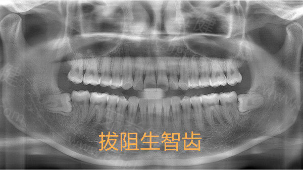 泰康拜博口腔医院拔牙、拔智齿多少钱？