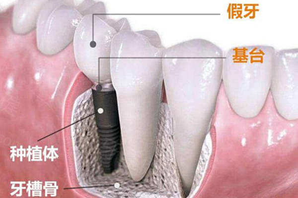 种植牙镶牙收费价格表