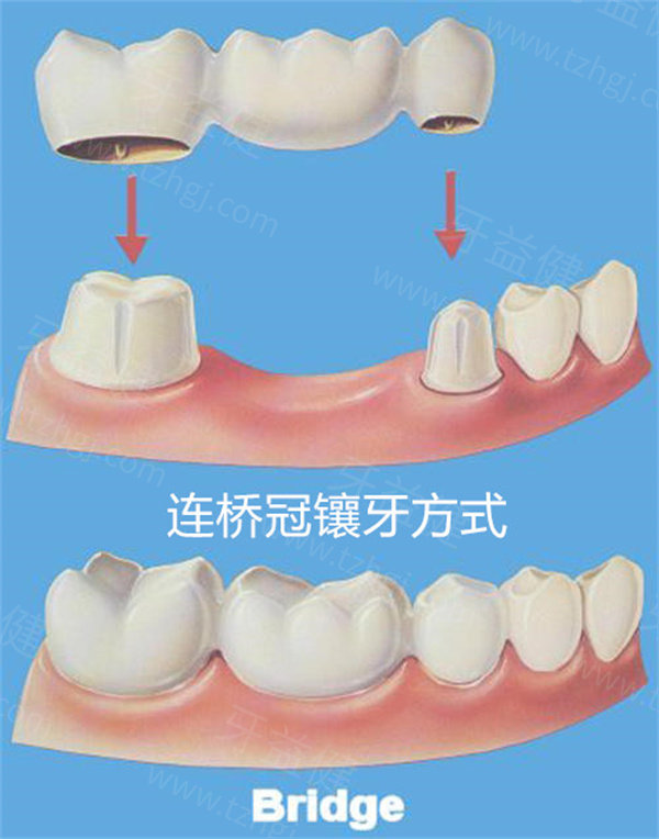 全瓷牙镶牙多少钱一颗