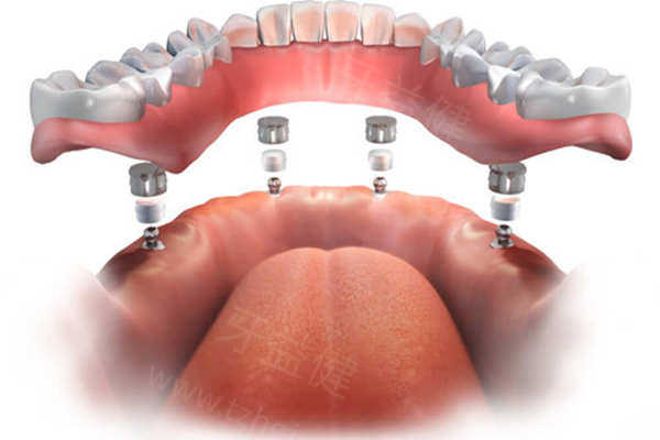南昌全口半固定种植牙收费标准