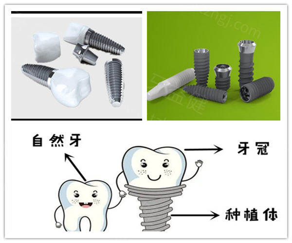 宁波国产种植牙多少钱一颗