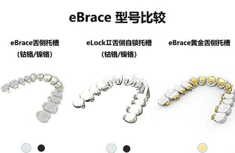 国产eBrace舌侧矫正器价格