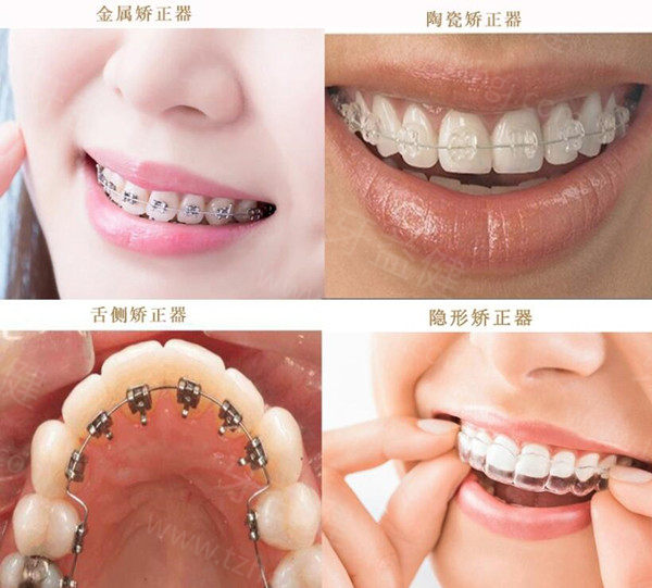 2025天津各口腔医院收费价目表:参考爱齿/美奥牙科种植牙/矫正费用明细