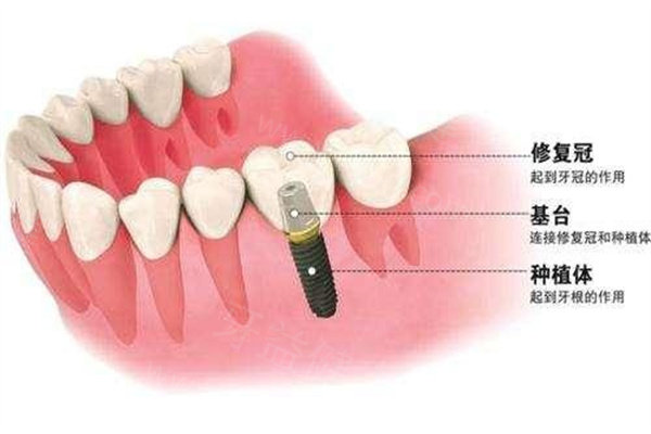 泉州牙科医院种植牙价格