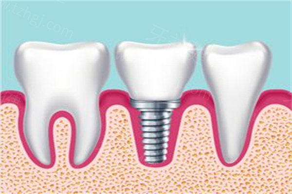 快来看最便宜的种植牙多少钱一颗？2025目前种植牙价格一览表含半全口种牙价格