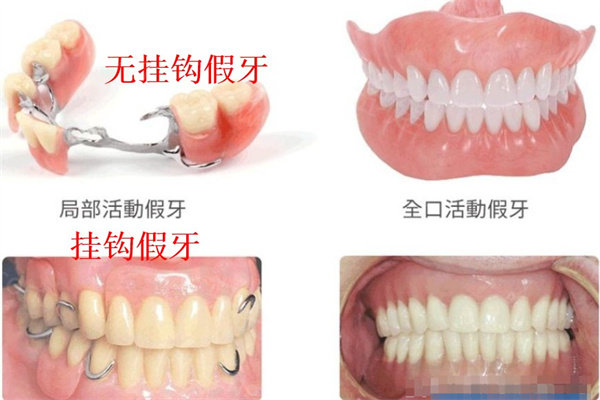 无挂钩假牙怎么样固定的