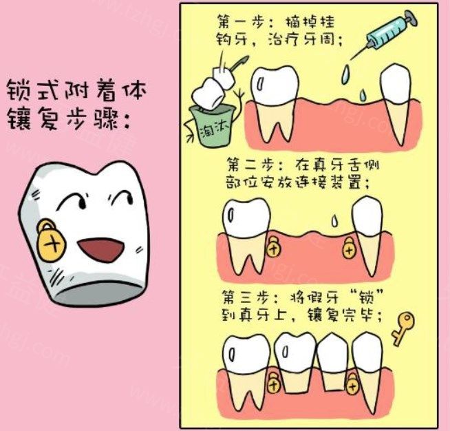 无挂钩假牙怎么样固定的