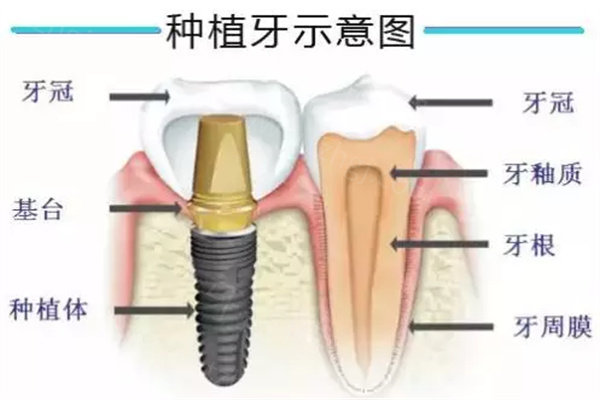 种植牙