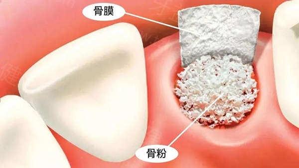 骨膜和骨粉需要单独收费