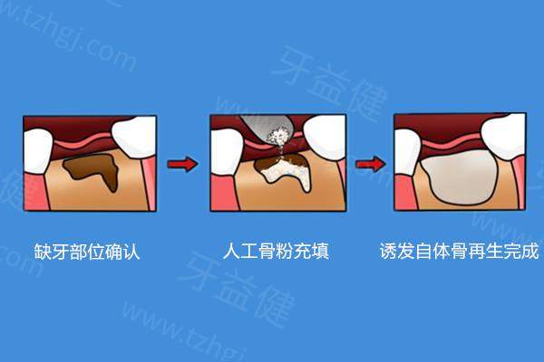 种植牙骨粉填充