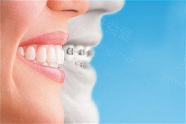 杭州富阳牙齿矫正价格 杭州富阳牙齿矫正价格