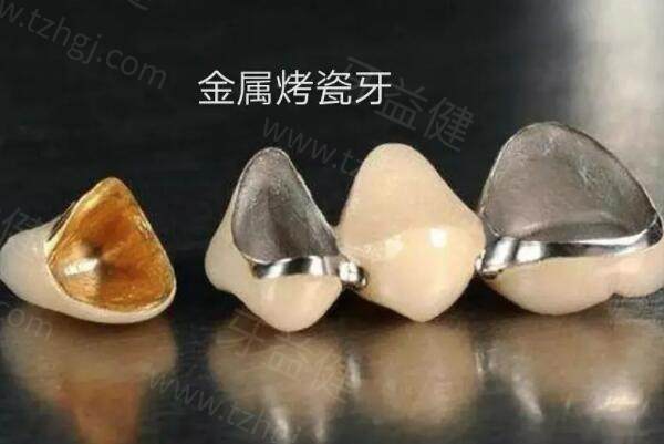 2025重庆北碚区看牙收费价目表大全:种植牙/全瓷牙冠/正畸收费贵不贵