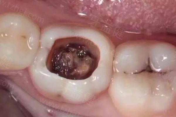 补牙 补牙