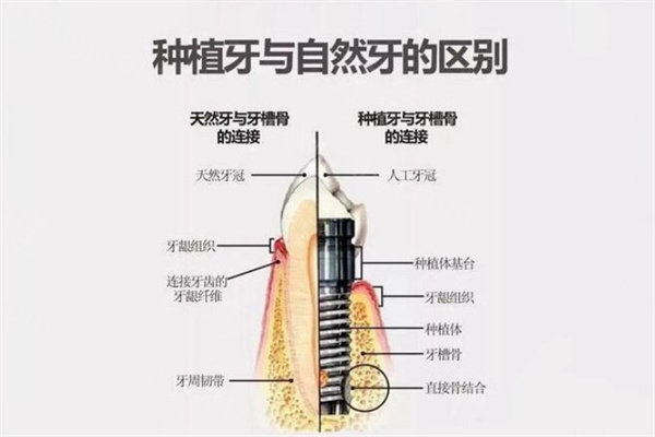 种植牙和真牙对比