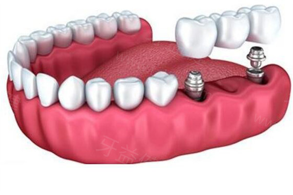 乌鲁木齐全口种植牙价格