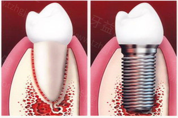 太原口腔医院种植牙多少钱一颗？
