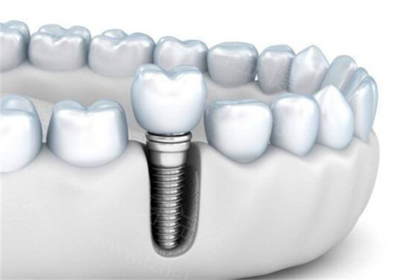 温州种植牙医院排名前三