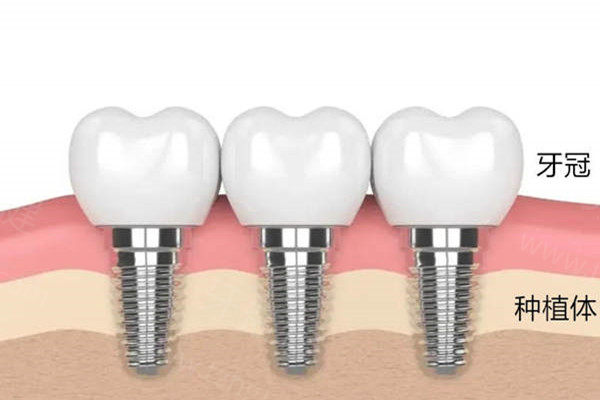 宁波种植牙哪家医院好又便宜？