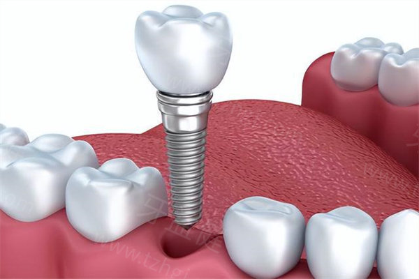 宁波种植牙哪家医院好