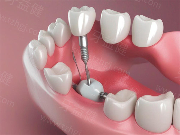 苏州牙科医院种植牙收费价格表