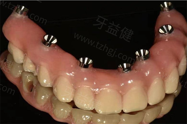 上海鼎植口腔医院全口假牙价格