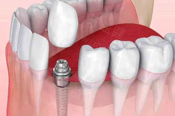 兰州种植牙多少钱一颗2025价格表：国产/进口/半全口种植牙4000元起