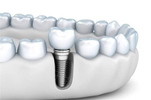 长沙雨花区种植牙医院排名：上榜的是技术和口碑都好的牙科