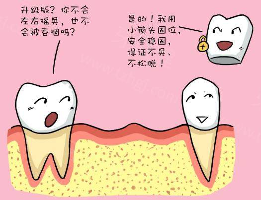 来看德国无挂钩精密假牙的优缺点和费用4.jpg