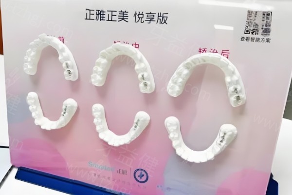 正雅隐形矫正价格表 正雅隐形矫正价格表