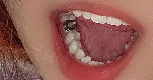 微笑口腔补牙多少钱一颗？