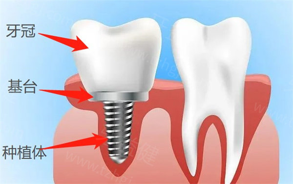种植牙