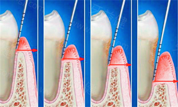 牙周治疗