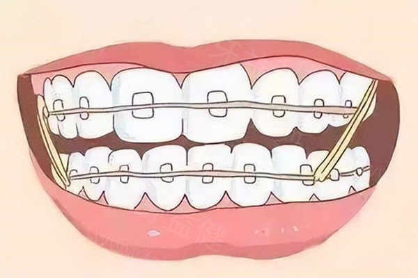 乌鲁木齐成人牙齿矫正价格