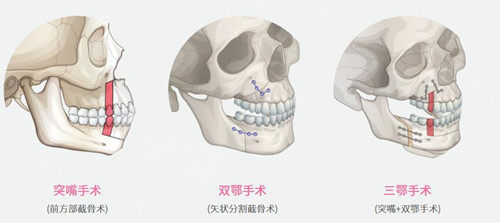 正颌二次修复技术