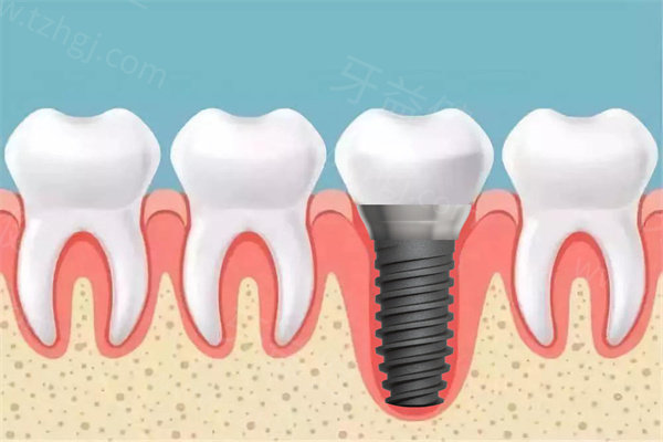 成都种植牙多少钱一颗?参考2025成都单颗/半全口种植牙集采价格表来看很便宜