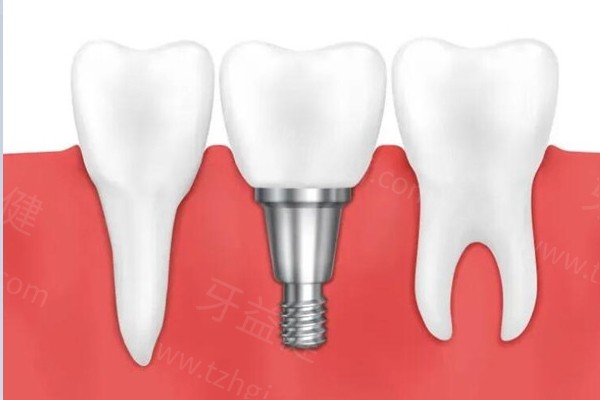 种植牙推荐与价格解析指南：多方面解析各种植体优势与价格参考