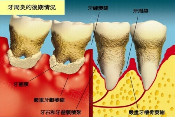 牙龈萎缩早期和晚期的图片对比