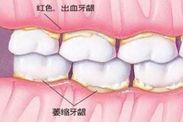 牙龈萎缩早期和晚期的图片对比